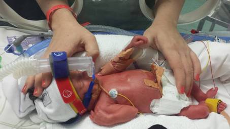 Hannah pictured at two days old. At birth she weighed 1145 grams, was 35cm long, and had a head circumference of 25cm. Photo: Supplied