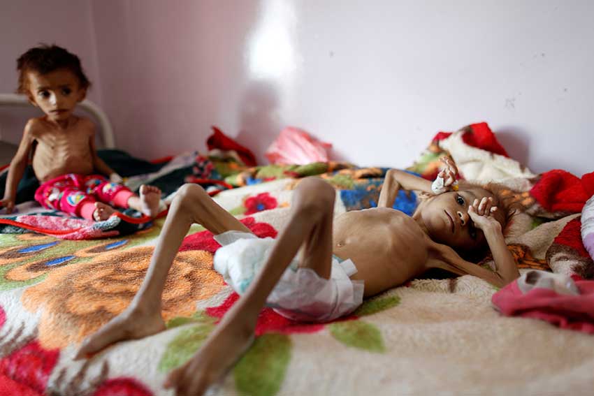 Children suffer in Yemen